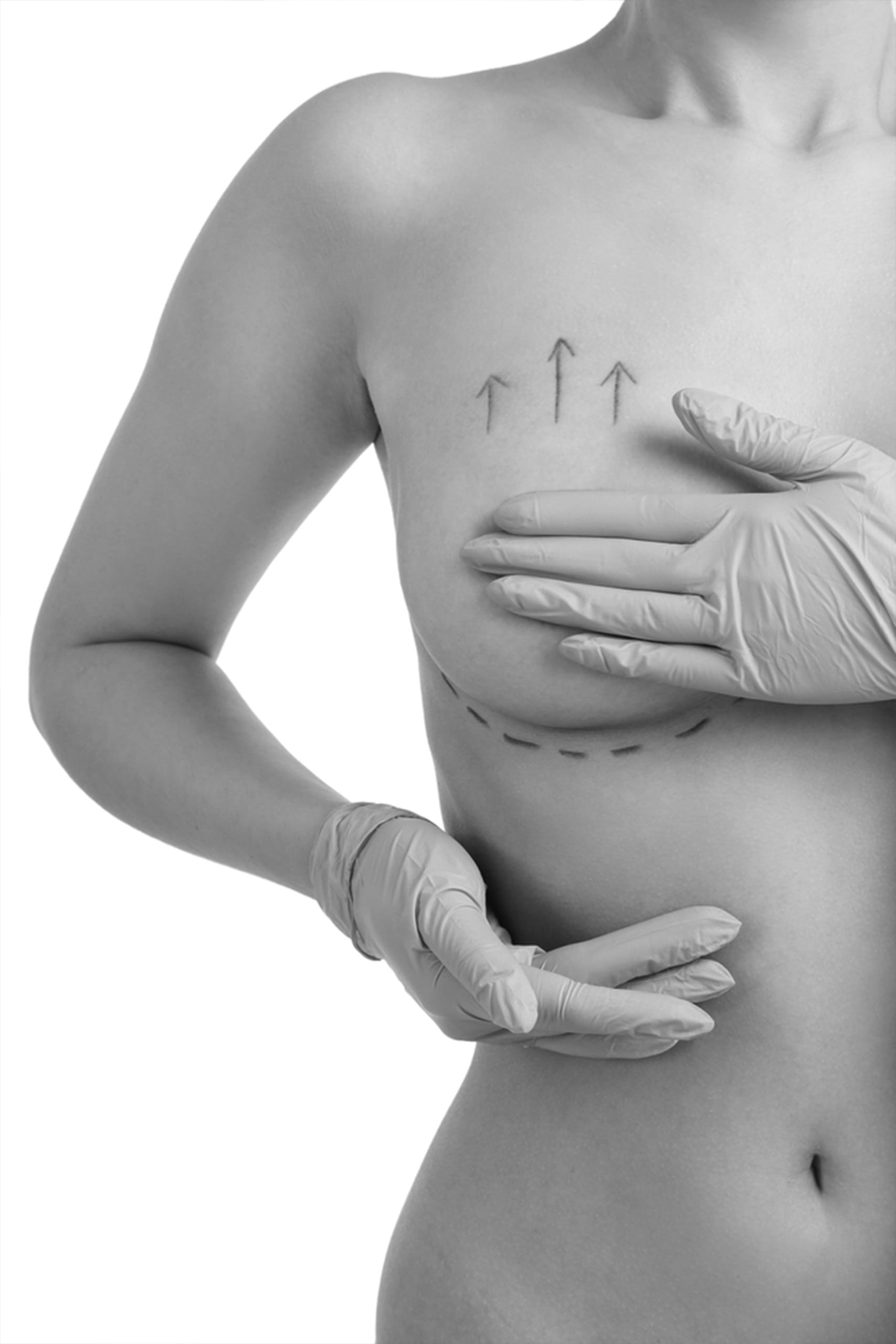 Operatie de ridicare a sanilor 2