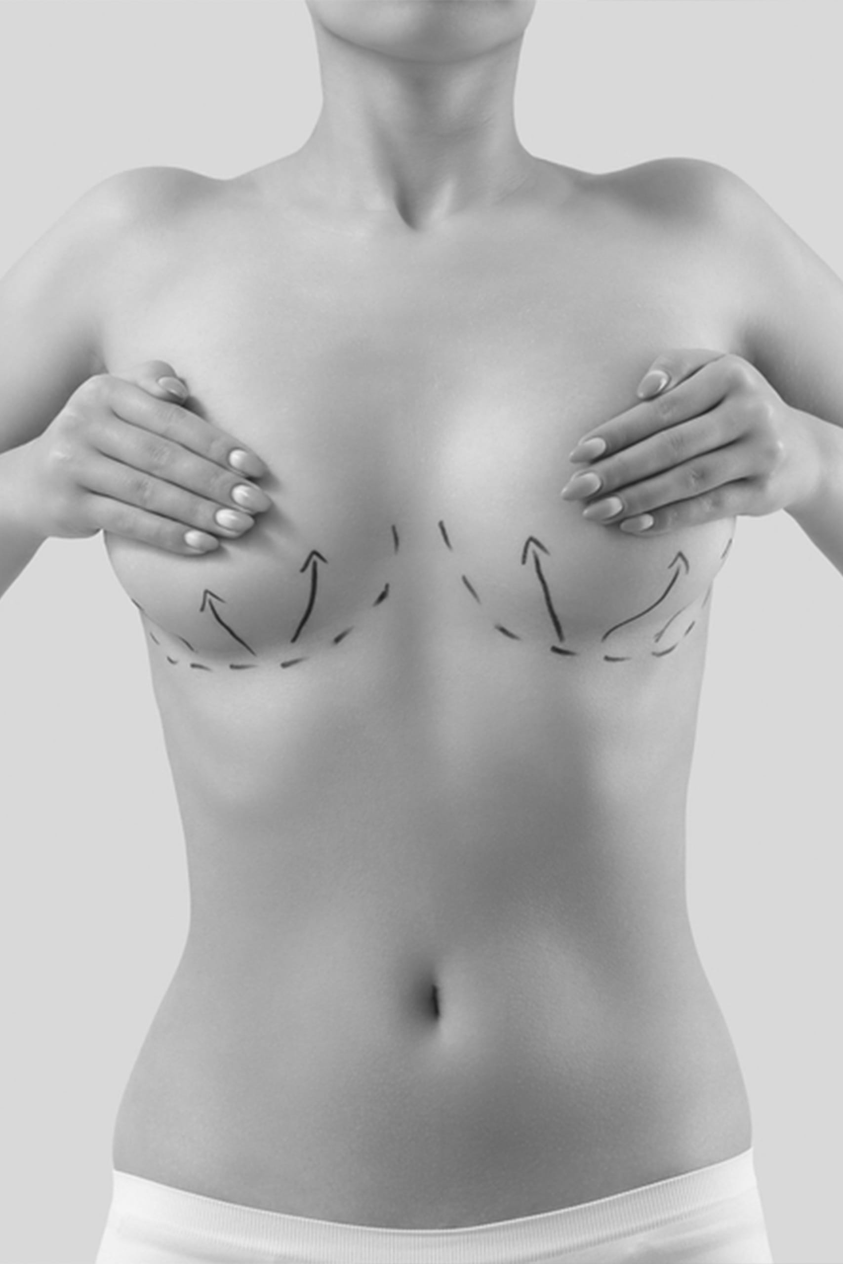 Operatie de ridicare a sanilor 3