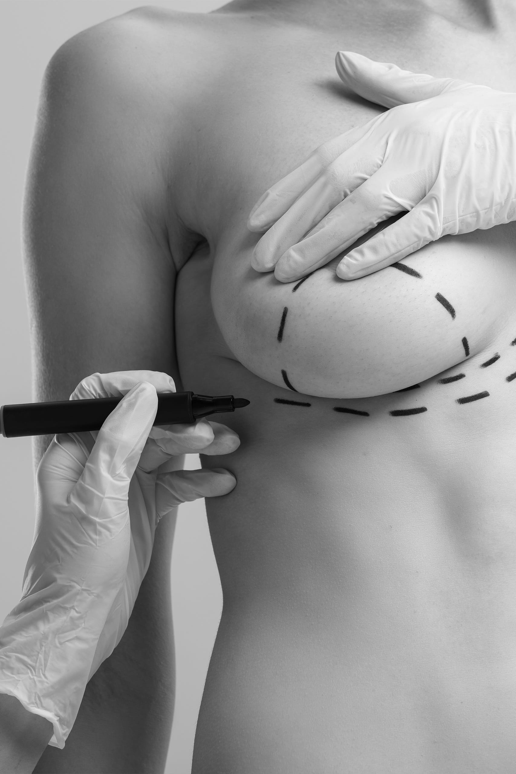 Marirea sanilor cu implante mamare B lite 3