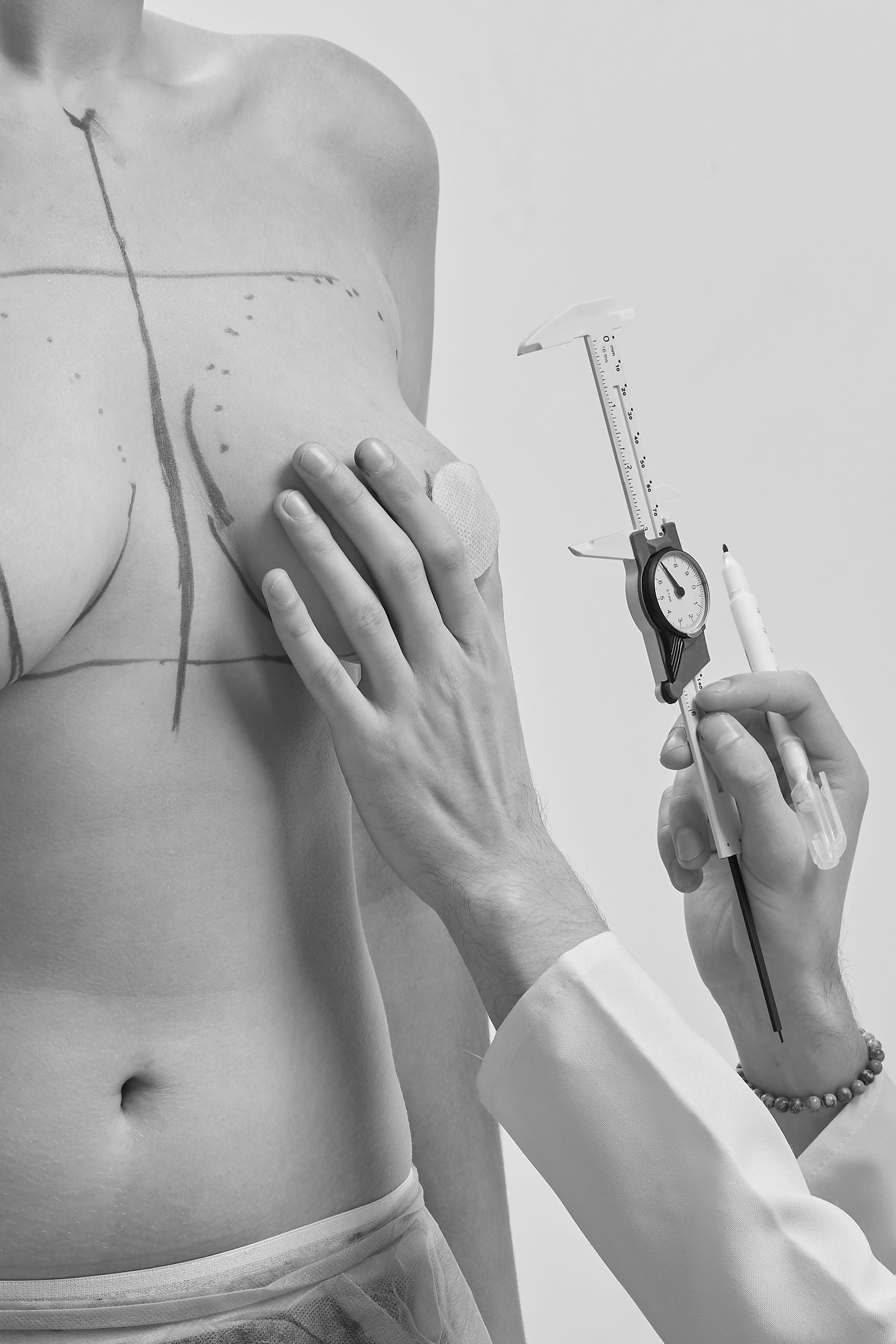 Operatia de simetrizare a sanilor 3