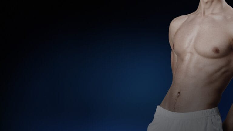 Operație ginecomastie