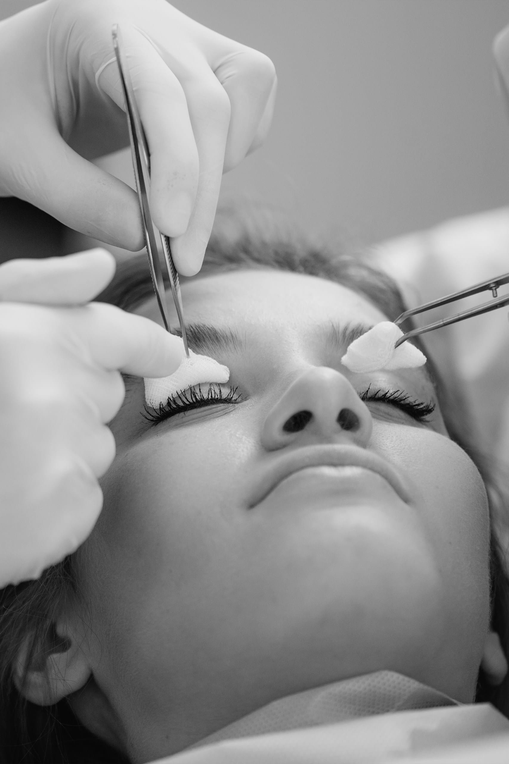 Blefaroplastie pleoapa superioara 2