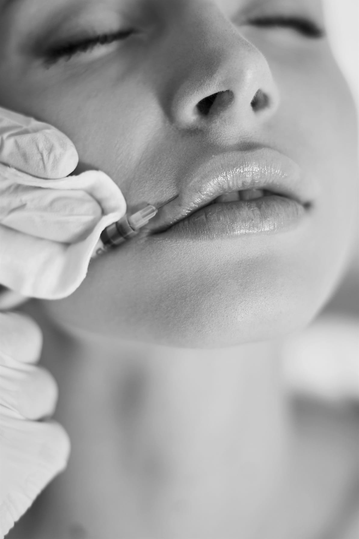 Lifting buza superioara gummysmile 3