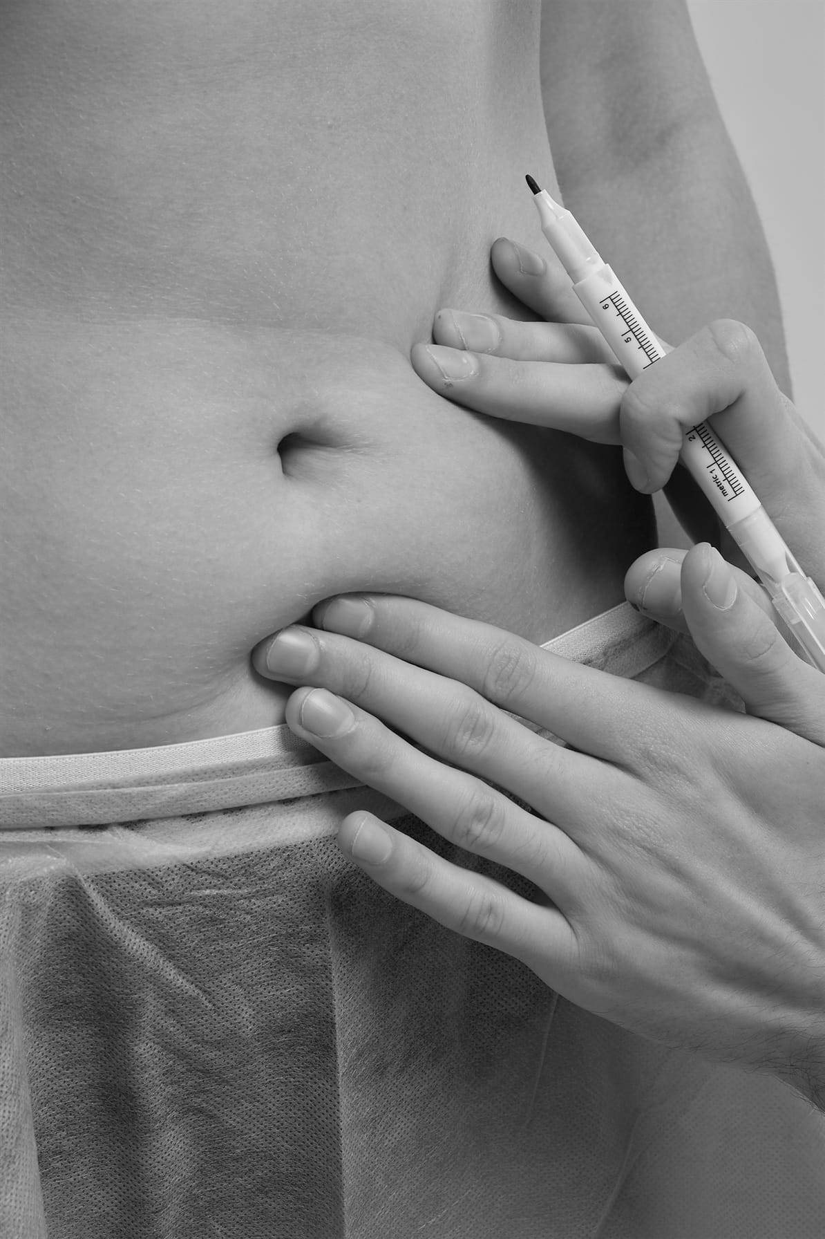 Liposuctia prin VASERLipo 2