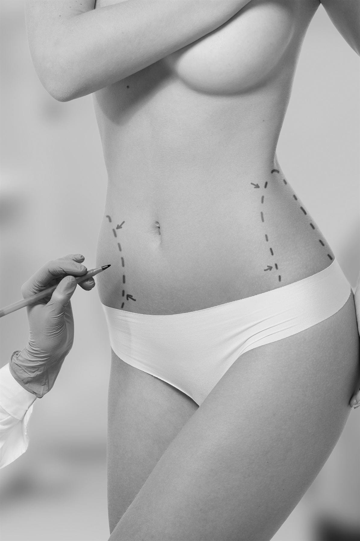 Operatia de abdominoplastie 1