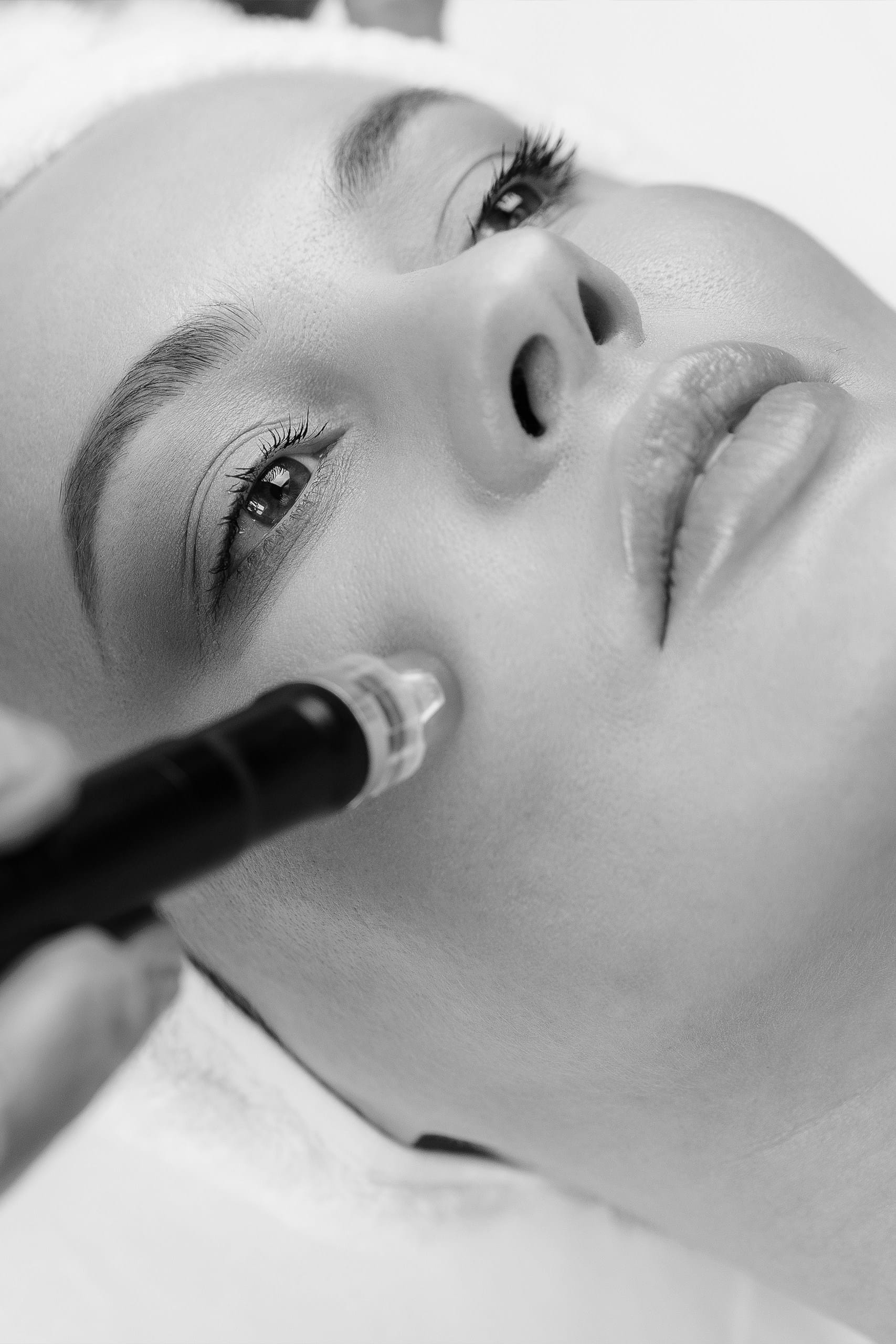 Microdermabraziune 3