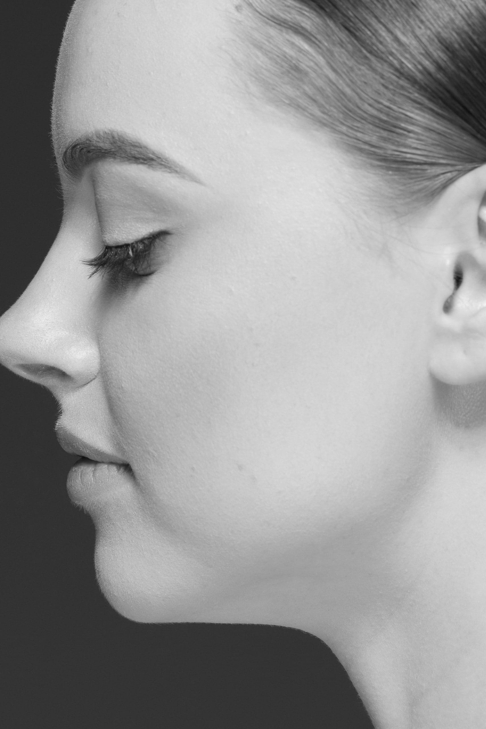 Rinoplastie ultrasonica 3