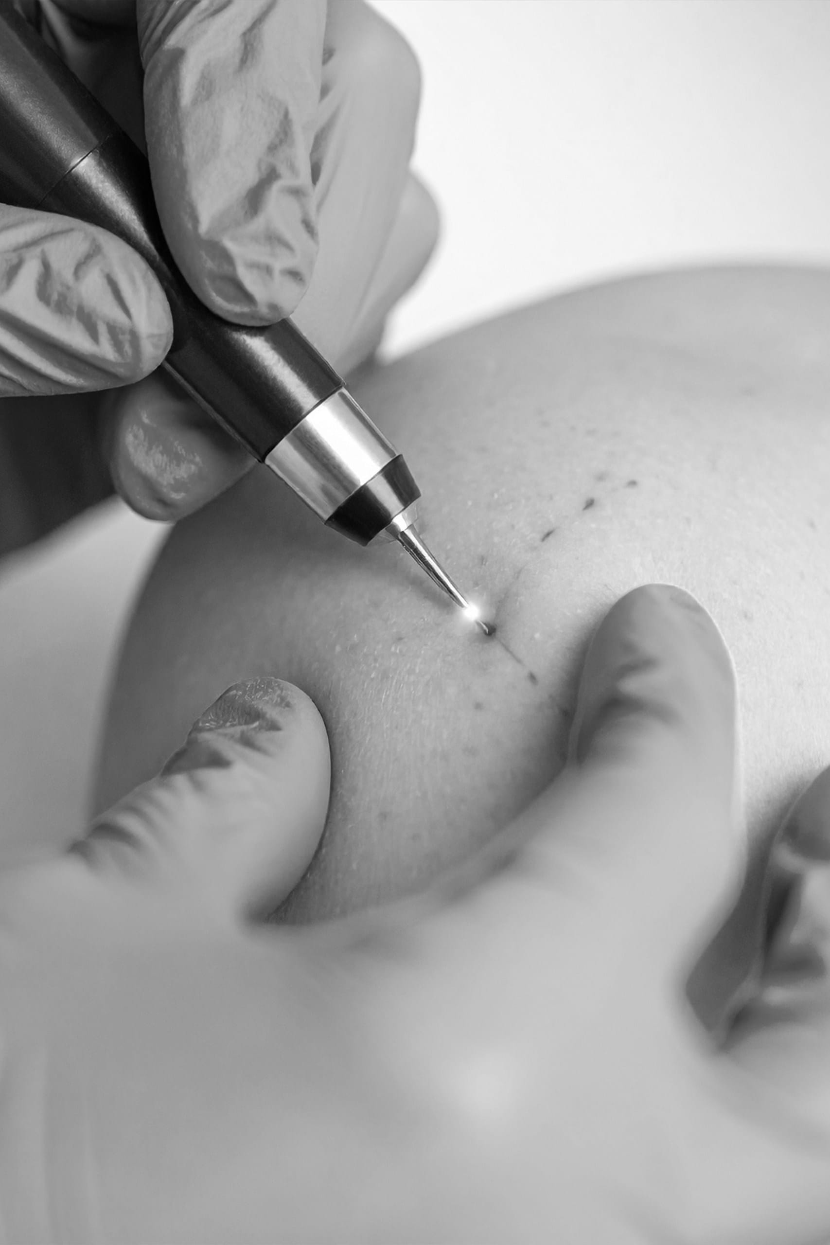 Tratament cicatrici cu laser CO2 1