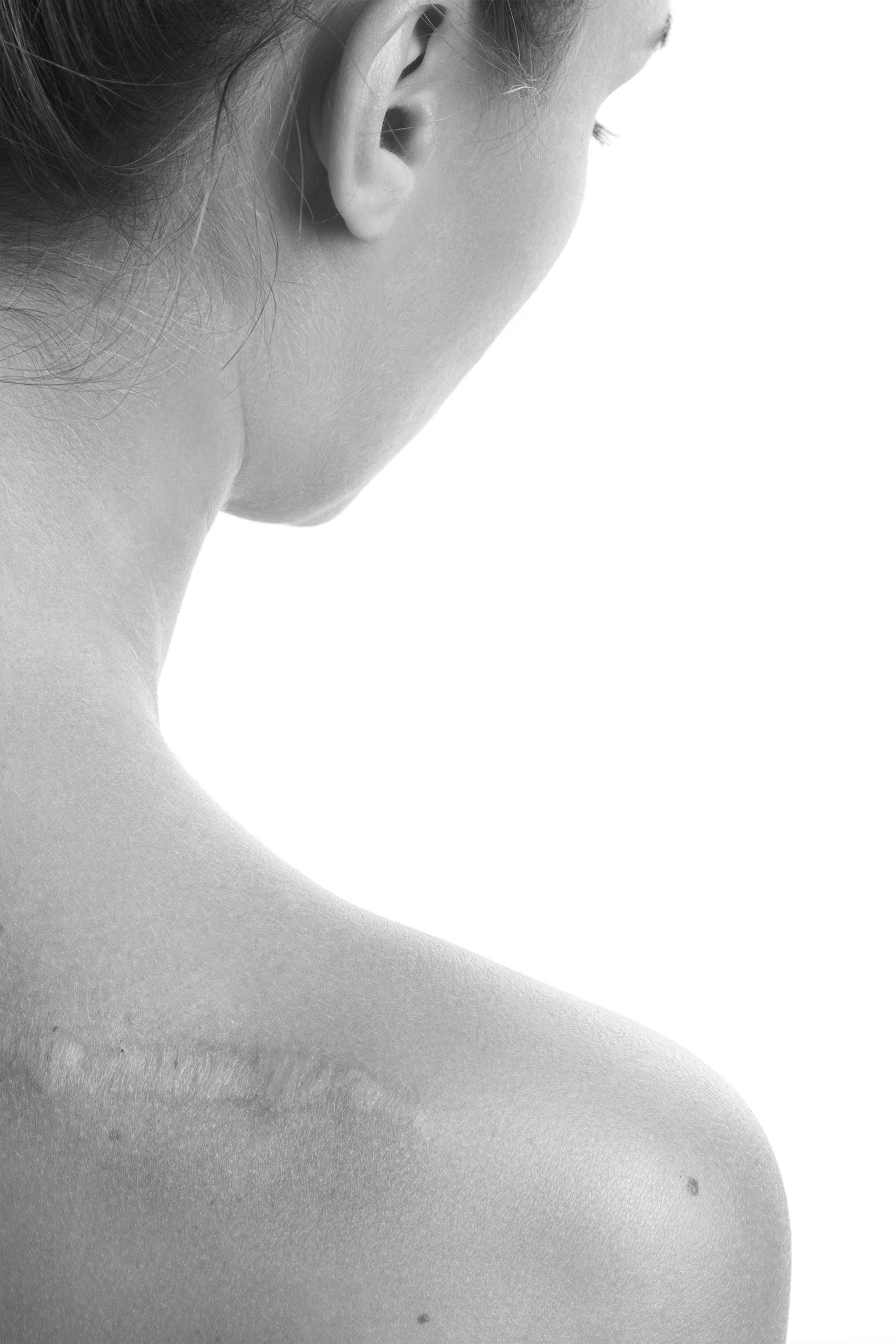 Tratament cicatrici cu laser CO2 3