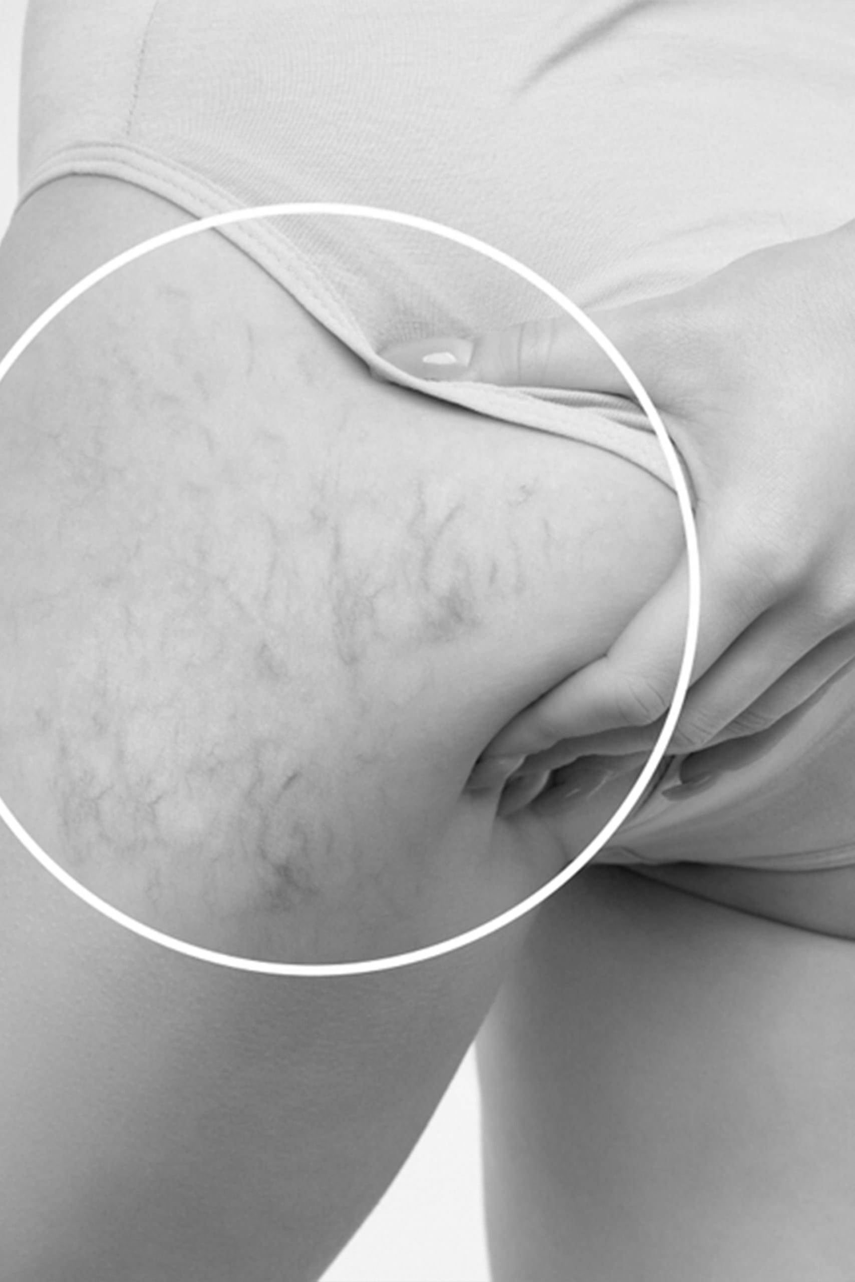 Tratamentul leziunilor vasculare cu laser dioda MeDioStar Asclepion 2