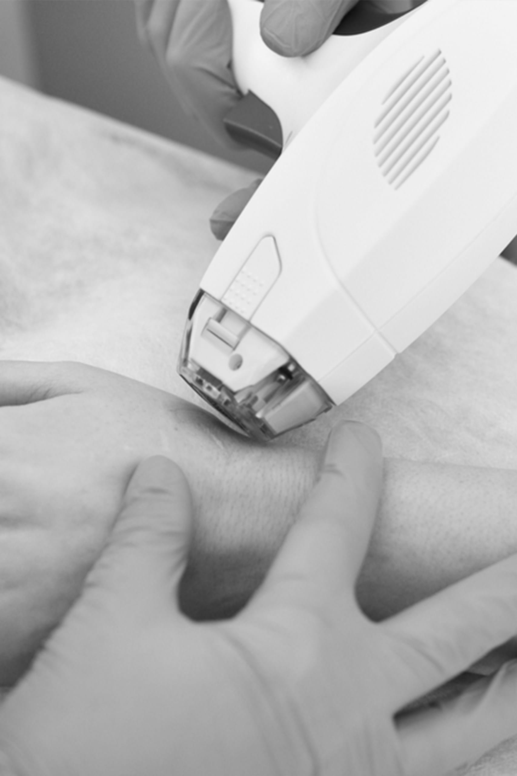 Tratamentul leziunilor vasculare cu laser dioda MeDioStar Asclepion 3