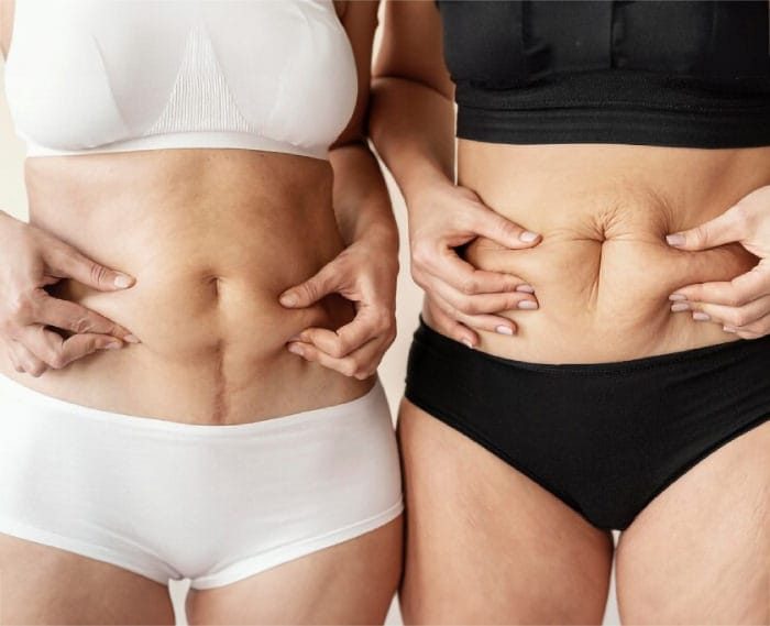 Grăsimea viscerală sau abdominală: ce rol are și ce e de făcut dacă este în exces?