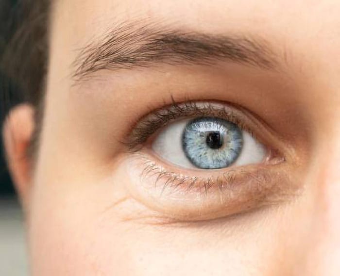 Ptoza palpebrală (pleoapele căzute): cauze și opțiuni de tratament