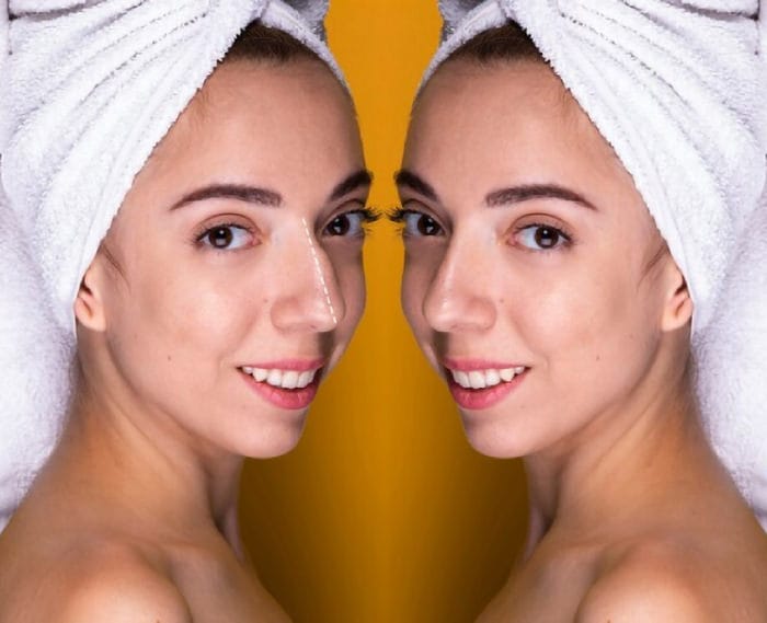 Ultrasonic Rhinoplasty: Myths Debunked and Truths Explained