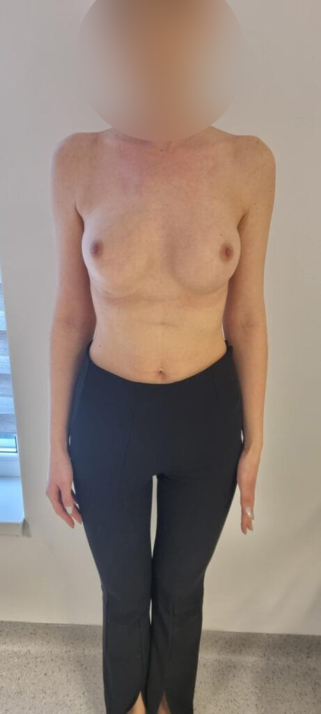 Gallery 169 Cazul nr. 4 - Augmentare mamară cu implant - Oh