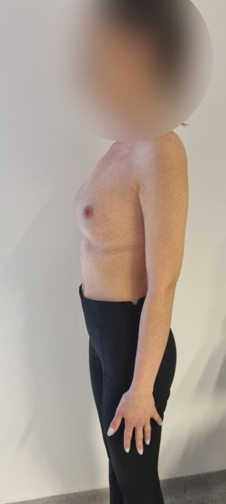 Gallery 171 Cazul nr. 4 - Augmentare mamară cu implant - Oh