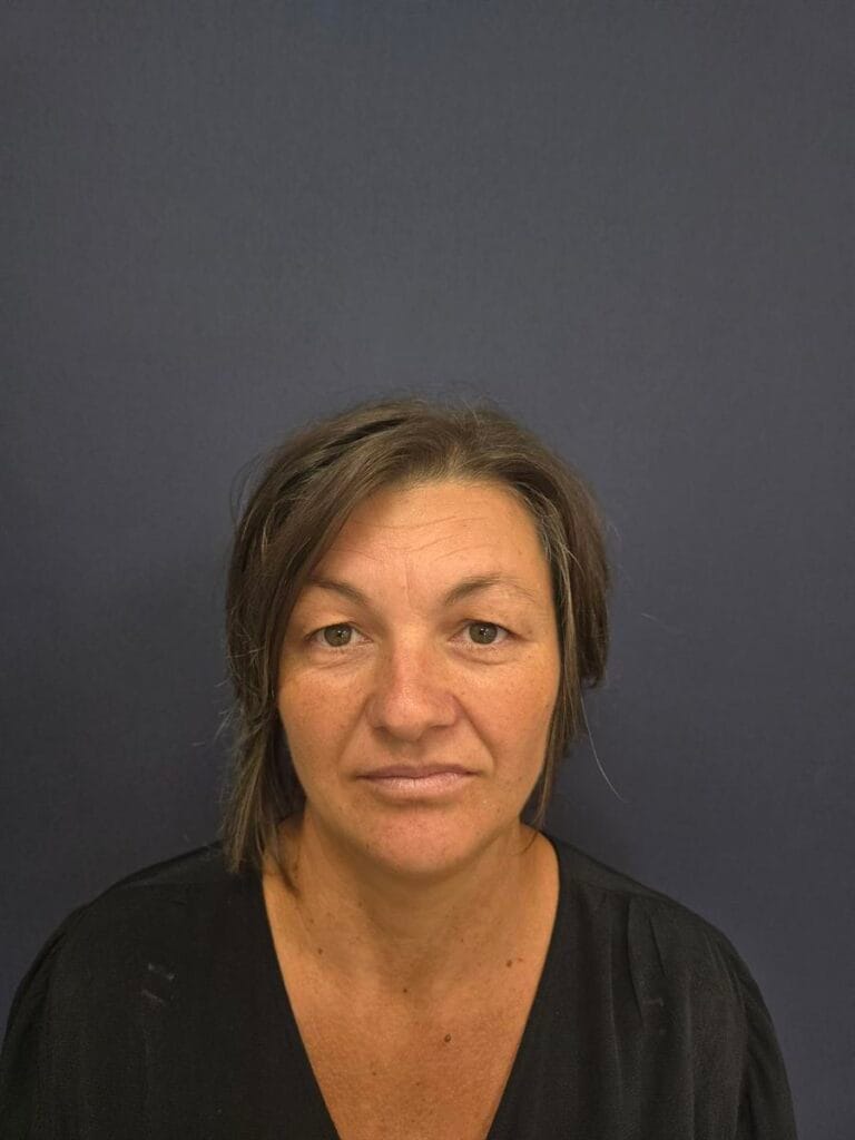 Gallery 294 Cazul nr. 2 - Blefaroplastie superioară - Oh