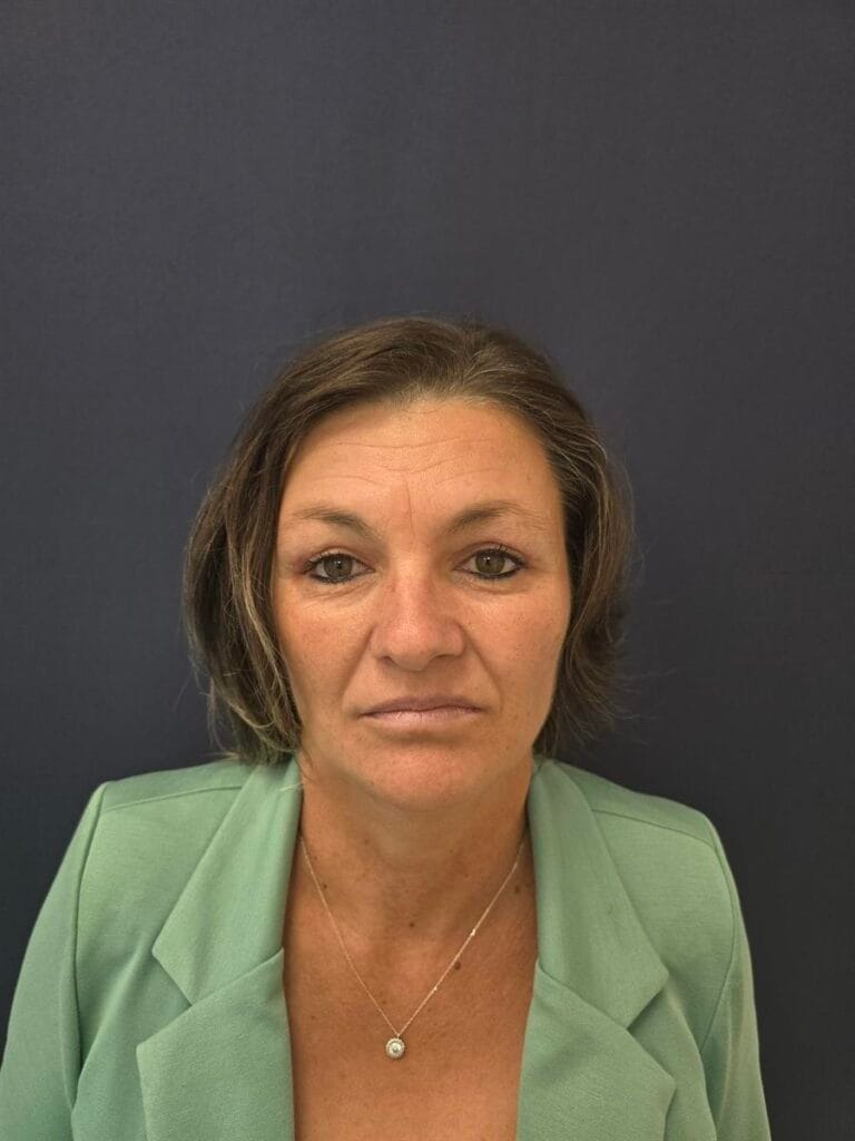 Gallery 296 Cazul nr. 2 - Blefaroplastie superioară - Oh