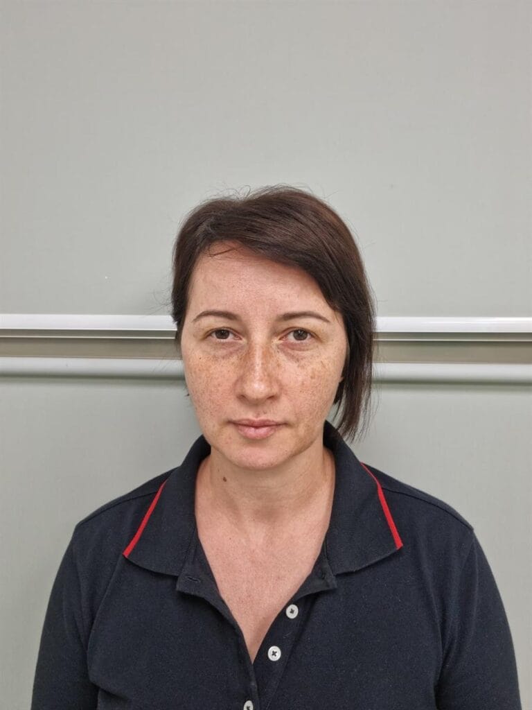 Gallery 301 Cazul nr. 3 - Blefaroplastie superioară - Oh