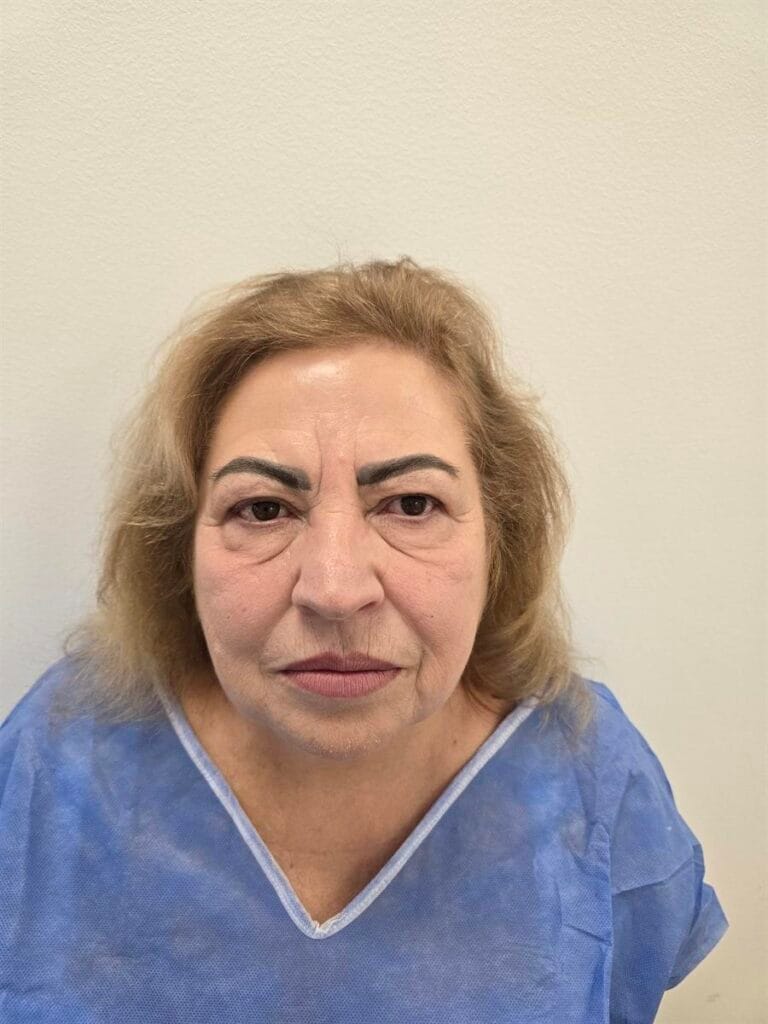 Gallery 307 Cazul nr. 4 - Blefaroplastie superioară - Oh