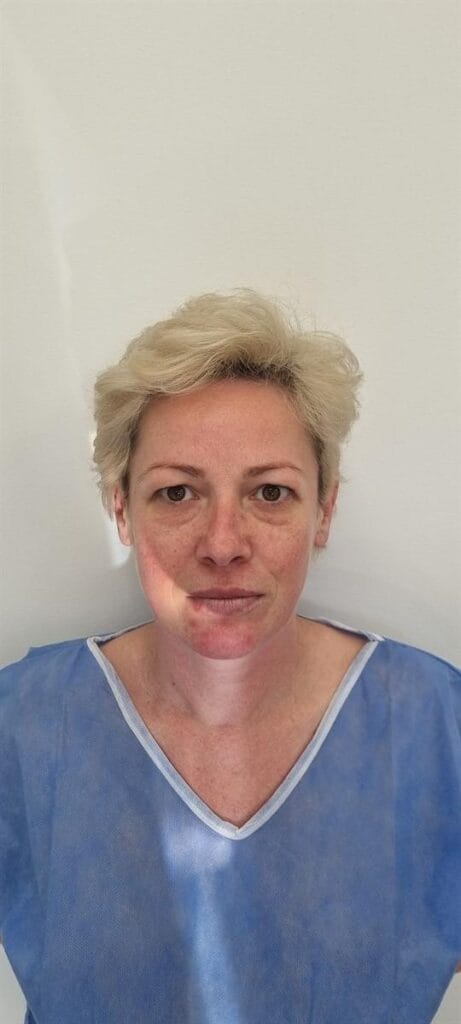 Gallery 306 Cazul nr. 4 - Blefaroplastie superioară - Oh