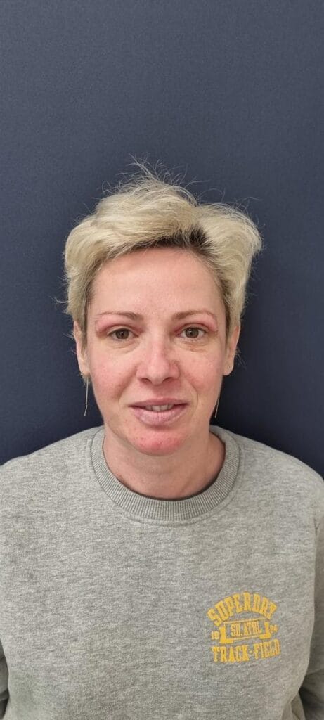 Gallery 308 Cazul nr. 4 - Blefaroplastie superioară - Oh