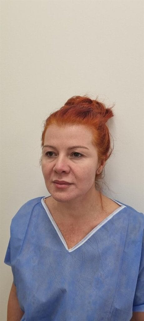 Gallery 317 Cazul nr. 5 - Blefaroplastie superioară - Oh