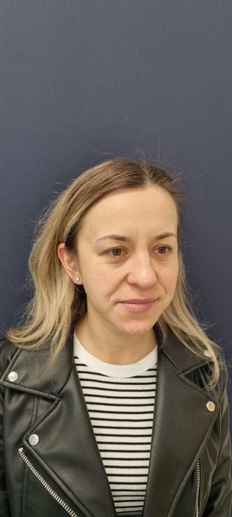 Gallery 332 Cazul nr. 8 - Blefaroplastie superioară - Oh