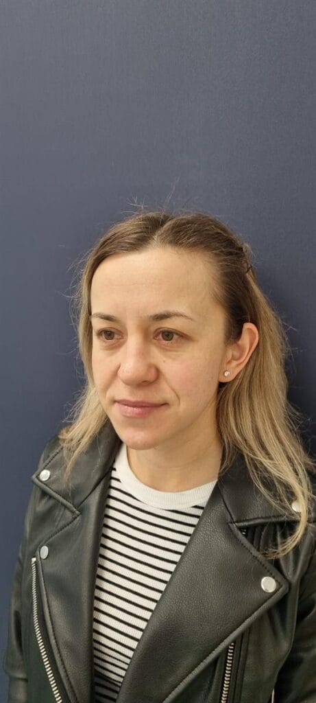 Gallery 334 Cazul nr. 8 - Blefaroplastie superioară - Oh