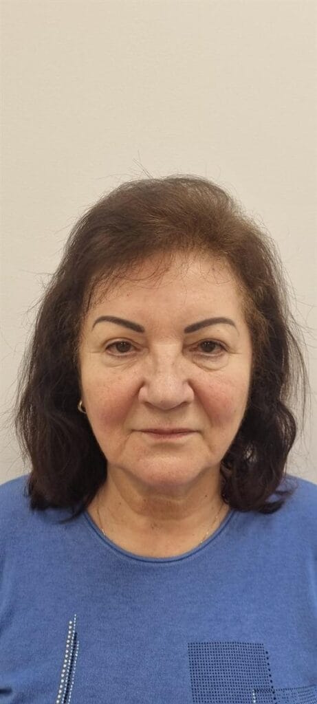 Gallery 336 Cazul nr. 9 - Blefaroplastie superioară - Oh