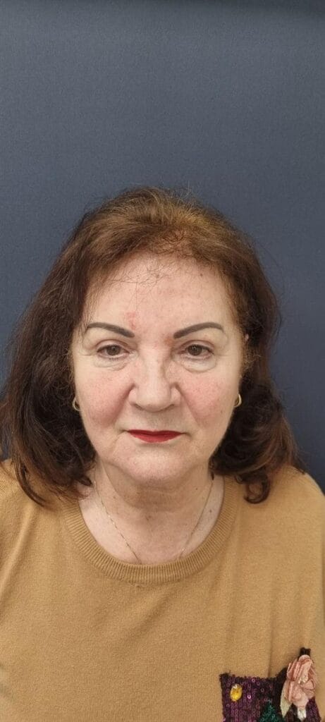 Gallery 337 Cazul nr. 9 - Blefaroplastie superioară - Oh