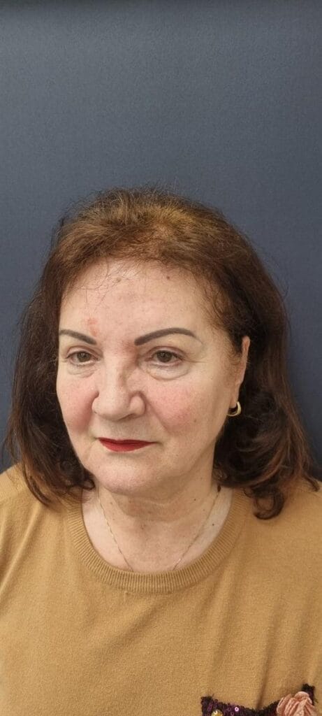 Gallery 339 Cazul nr. 9 - Blefaroplastie superioară - Oh