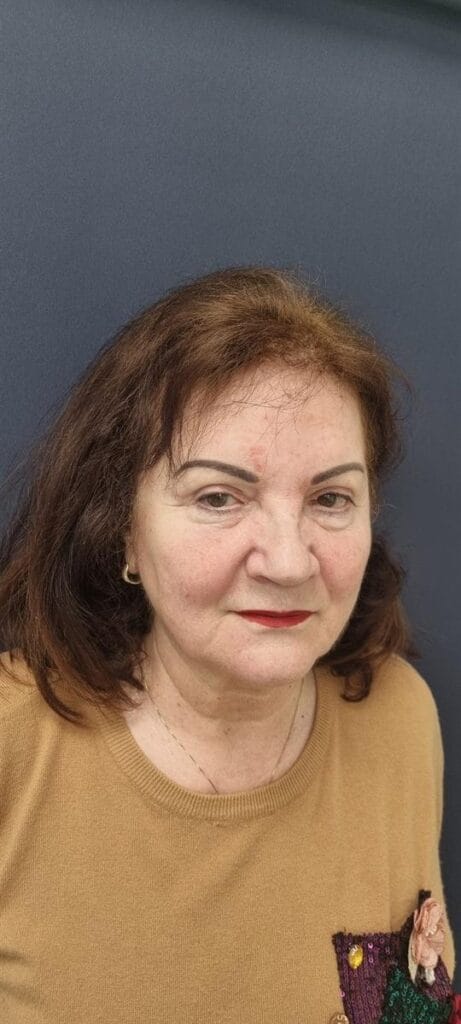 Gallery 341 Cazul nr. 9 - Blefaroplastie superioară - Oh