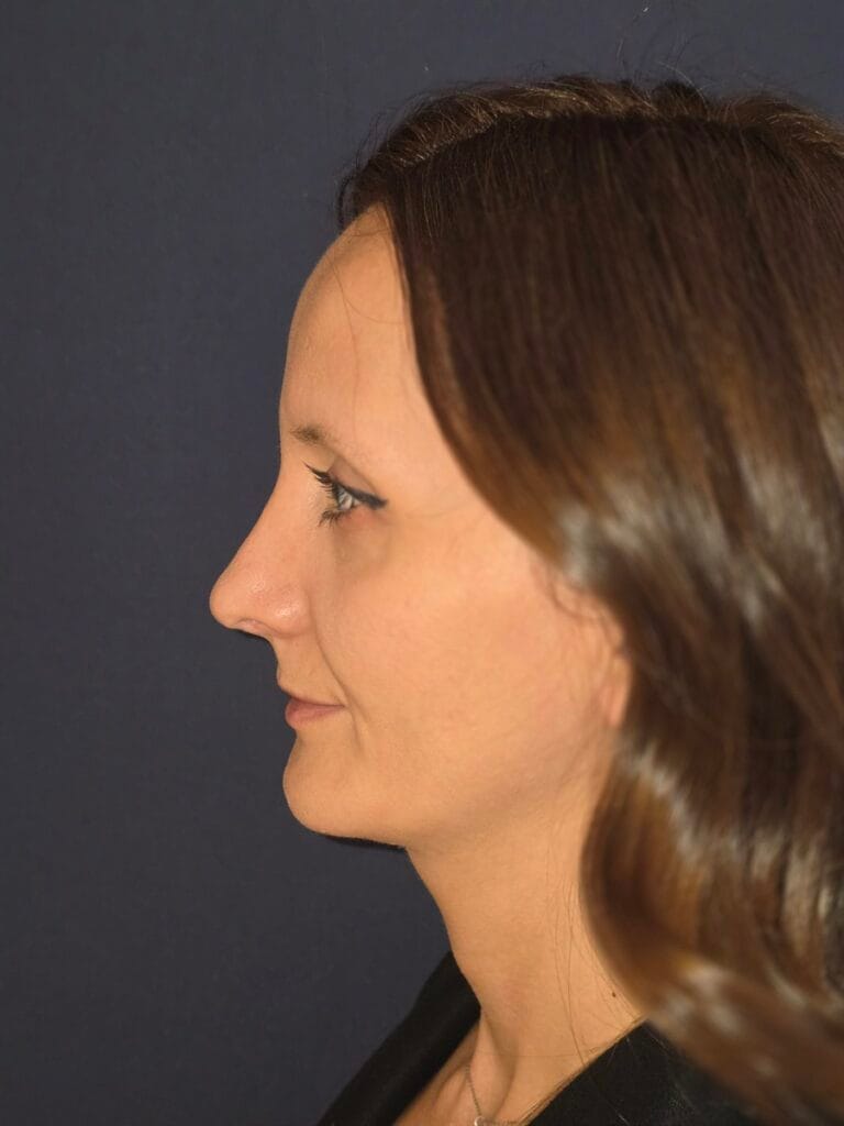 Gallery 343 Cazul nr. 1 - Genioplastie - Oh