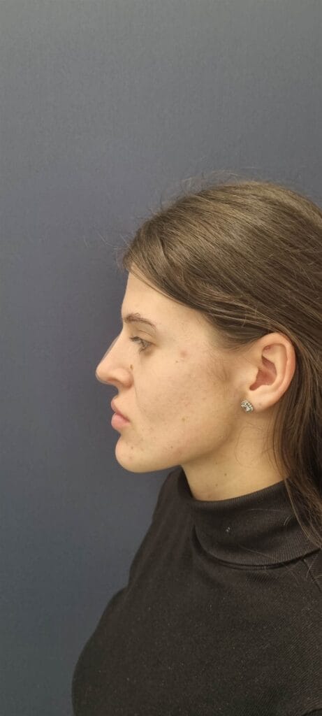 Gallery 348 Cazul nr. 2 - Genioplastie - Oh