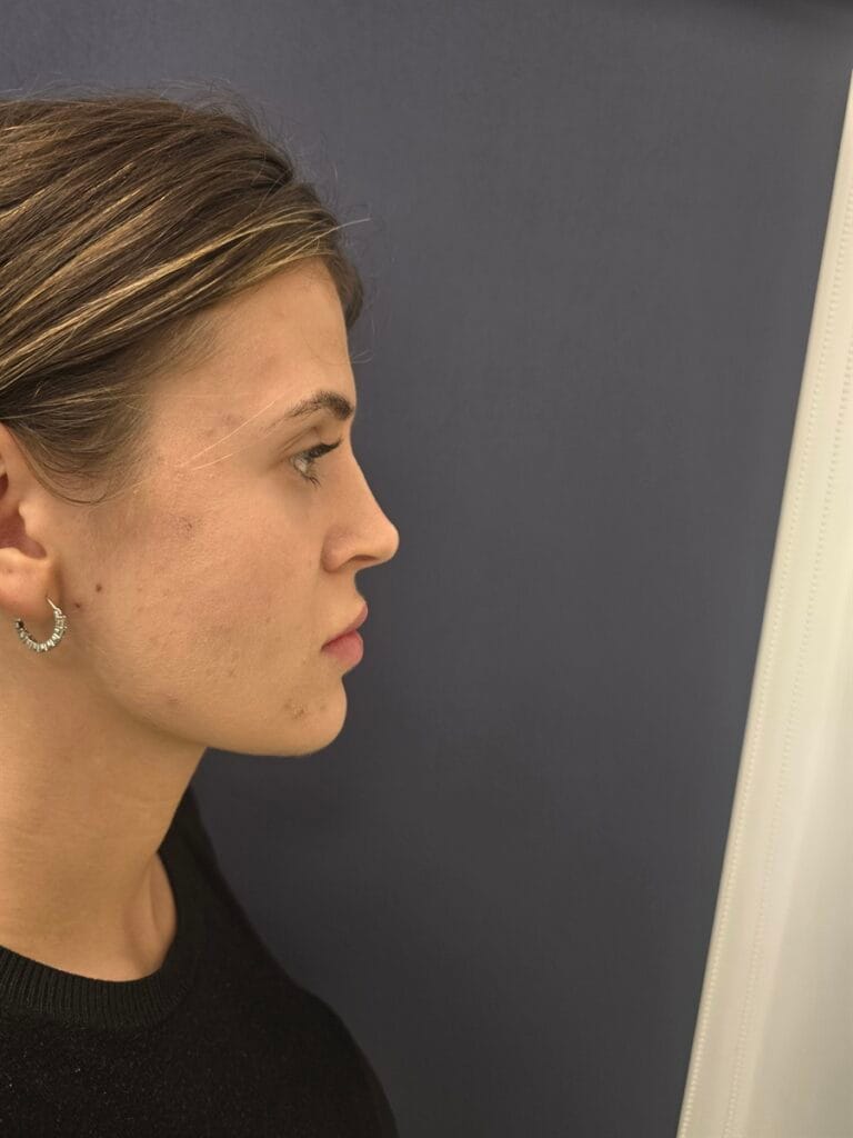 Gallery 351 Cazul nr. 2 - Genioplastie - Oh