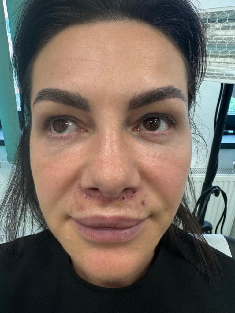 Gallery 353 Cazul nr. 1 - Lifting de buză liplift - Oh