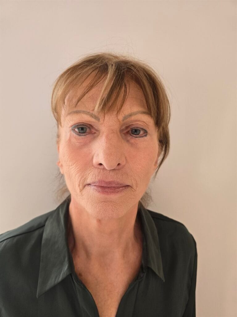 Gallery 383 Cazul nr. 1 - Lifting facial - Oh