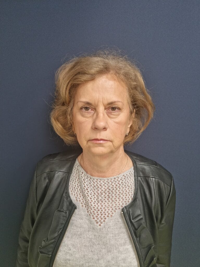 Gallery 388 Cazul nr. 2 - Lifting facial - Oh