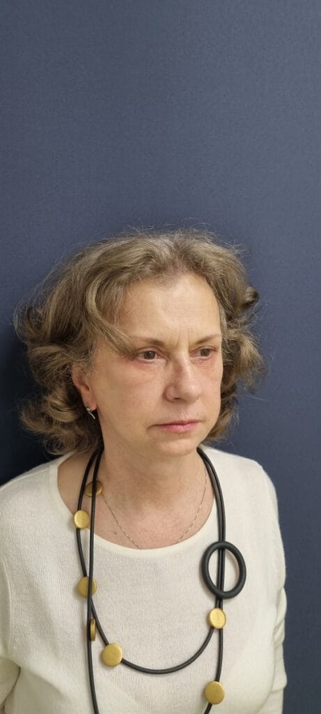 Gallery 391 Cazul nr. 2 - Lifting facial - Oh