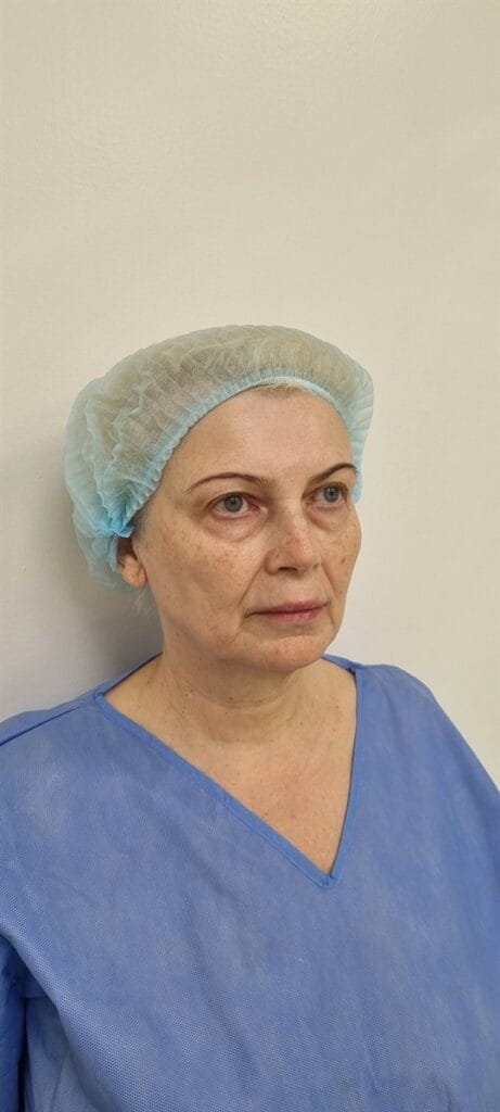 Gallery 410 Cazul nr. 2 - Lifting facial și Lifting gât - Oh