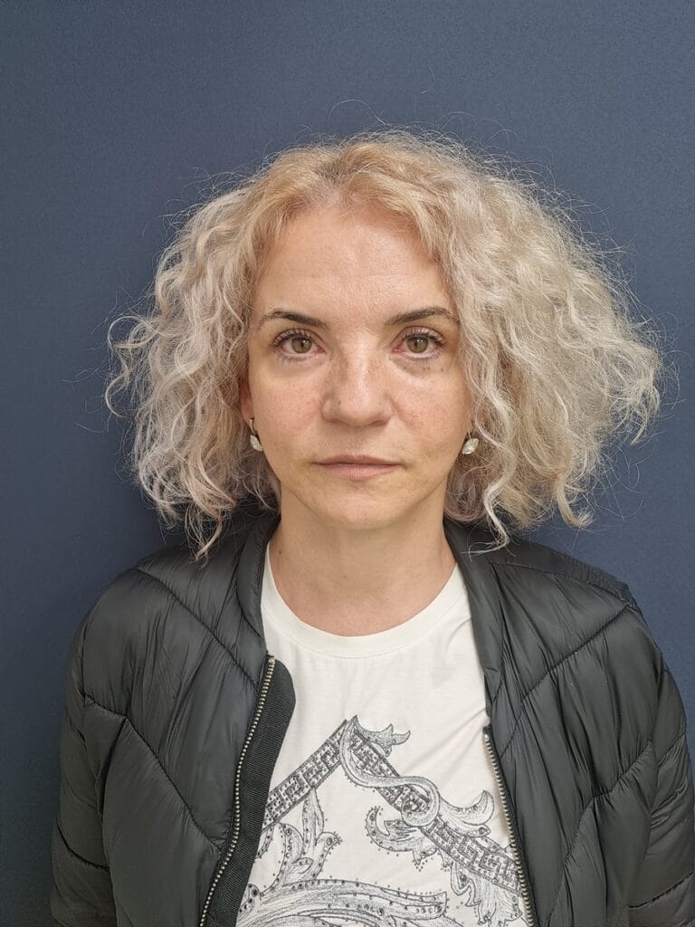 Gallery 413 Cazul nr. 3 - Lifting facial și Lifting gât - Oh