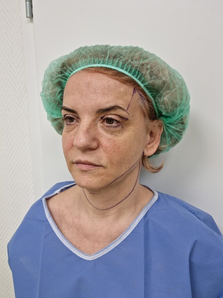 Gallery 414 Cazul nr. 3 - Lifting facial și Lifting gât - Oh