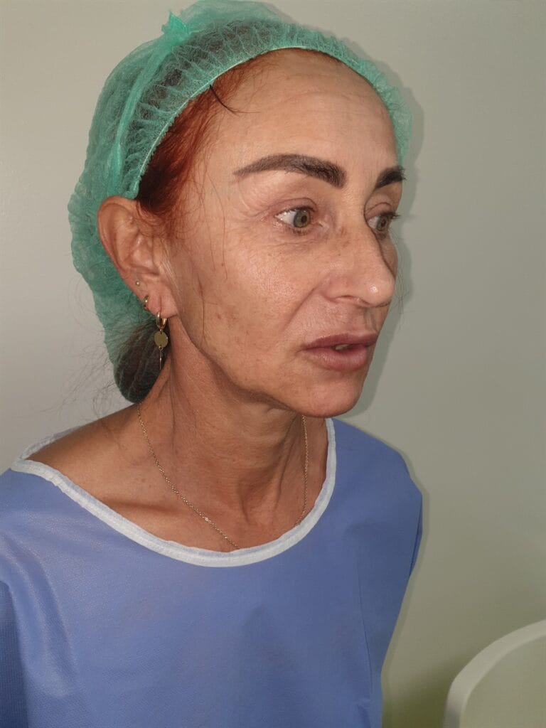 Gallery 422 Cazul nr. 4 - Lifting facial și Lifting gât - Oh