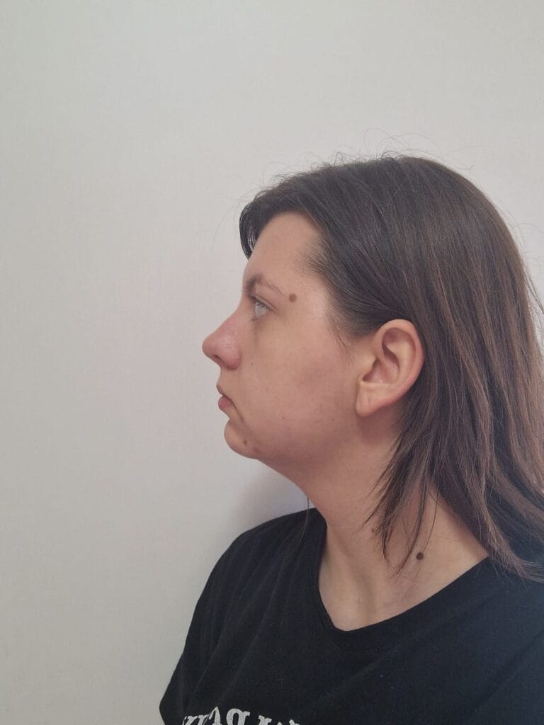 Gallery 484 Cazul nr. 1 - Liposucție gât - Oh