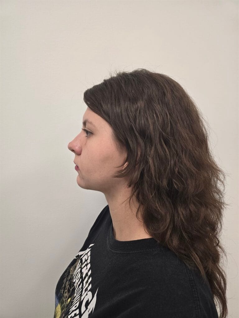 Gallery 485 Cazul nr. 1 - Liposucție gât - Oh