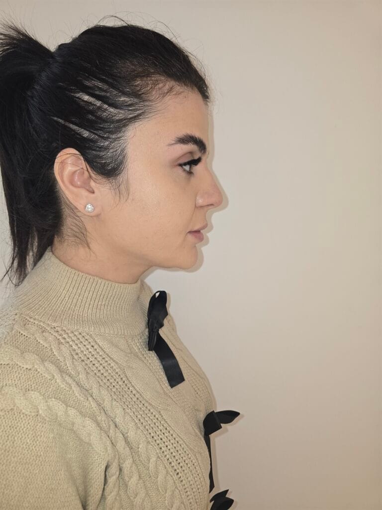 Gallery 495 Cazul nr. 2 - Liposucție gât - Oh