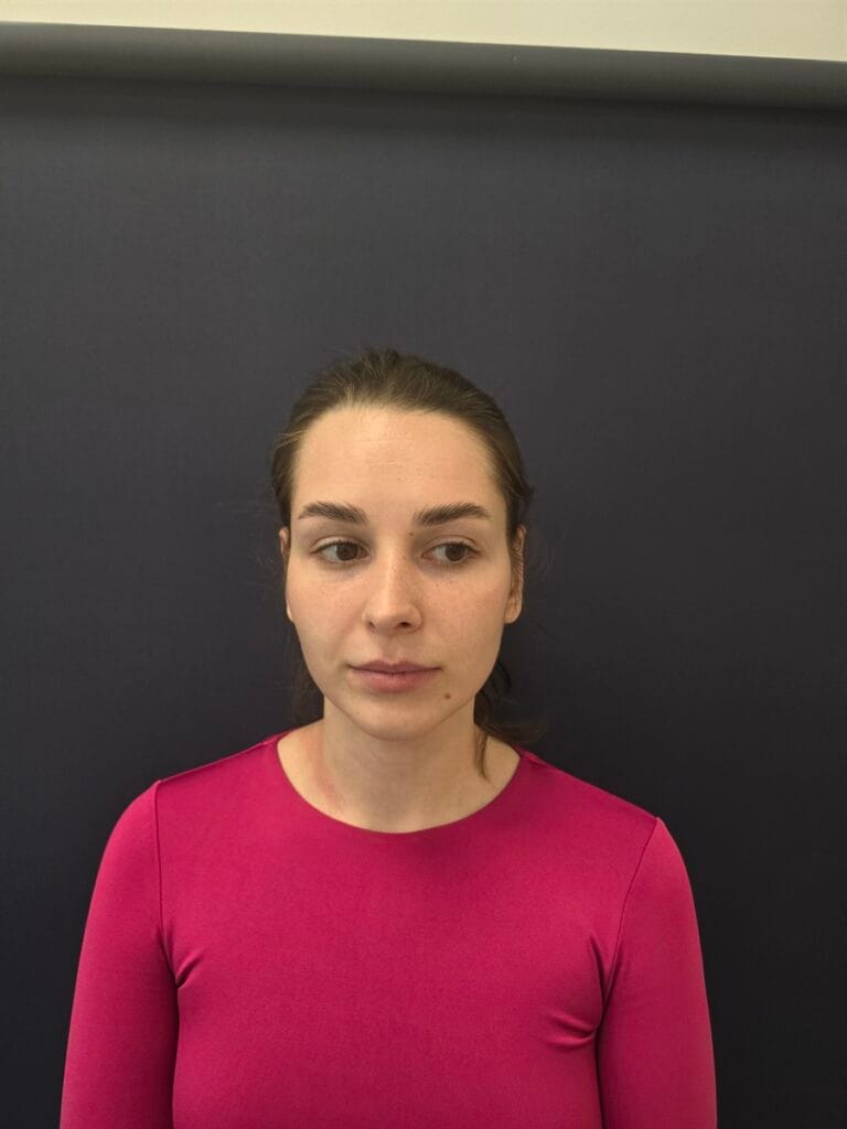 Cazul nr. 1 - Otoplastie - Oh