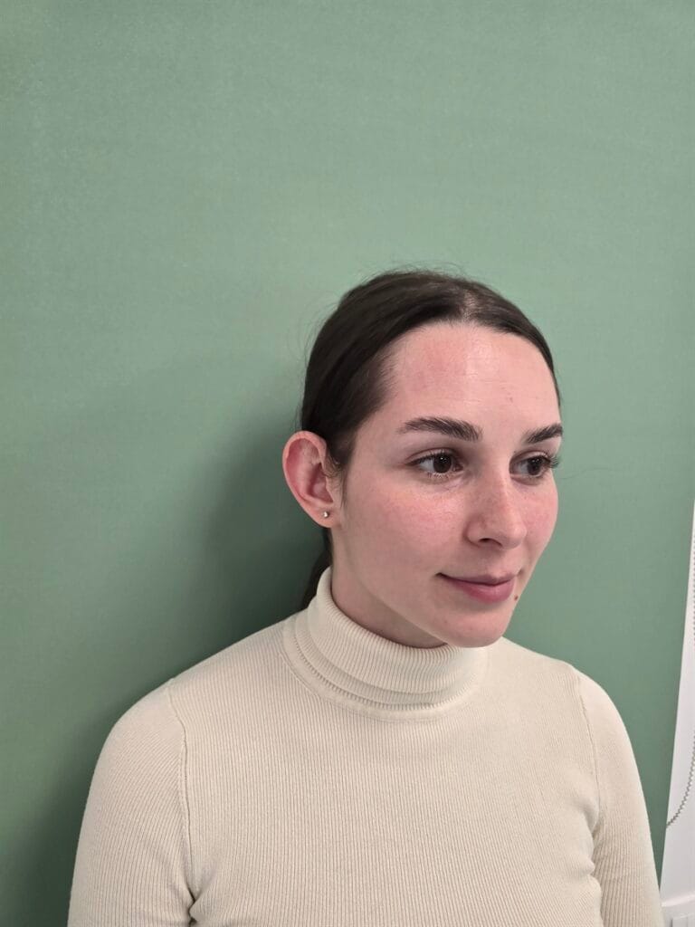 Cazul nr. 1 - Otoplastie - Oh