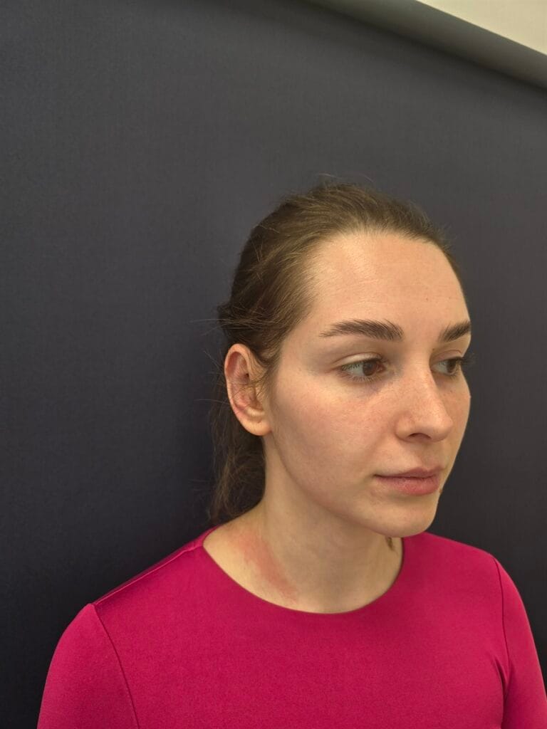 Cazul nr. 1 - Otoplastie - Oh